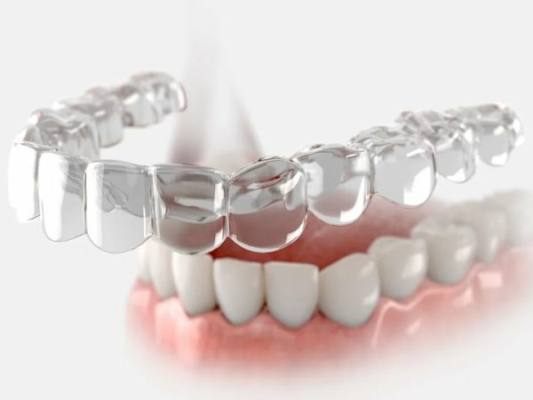 Прогрессивные методы коррекции зубов: Invisalign и FlexiLigner